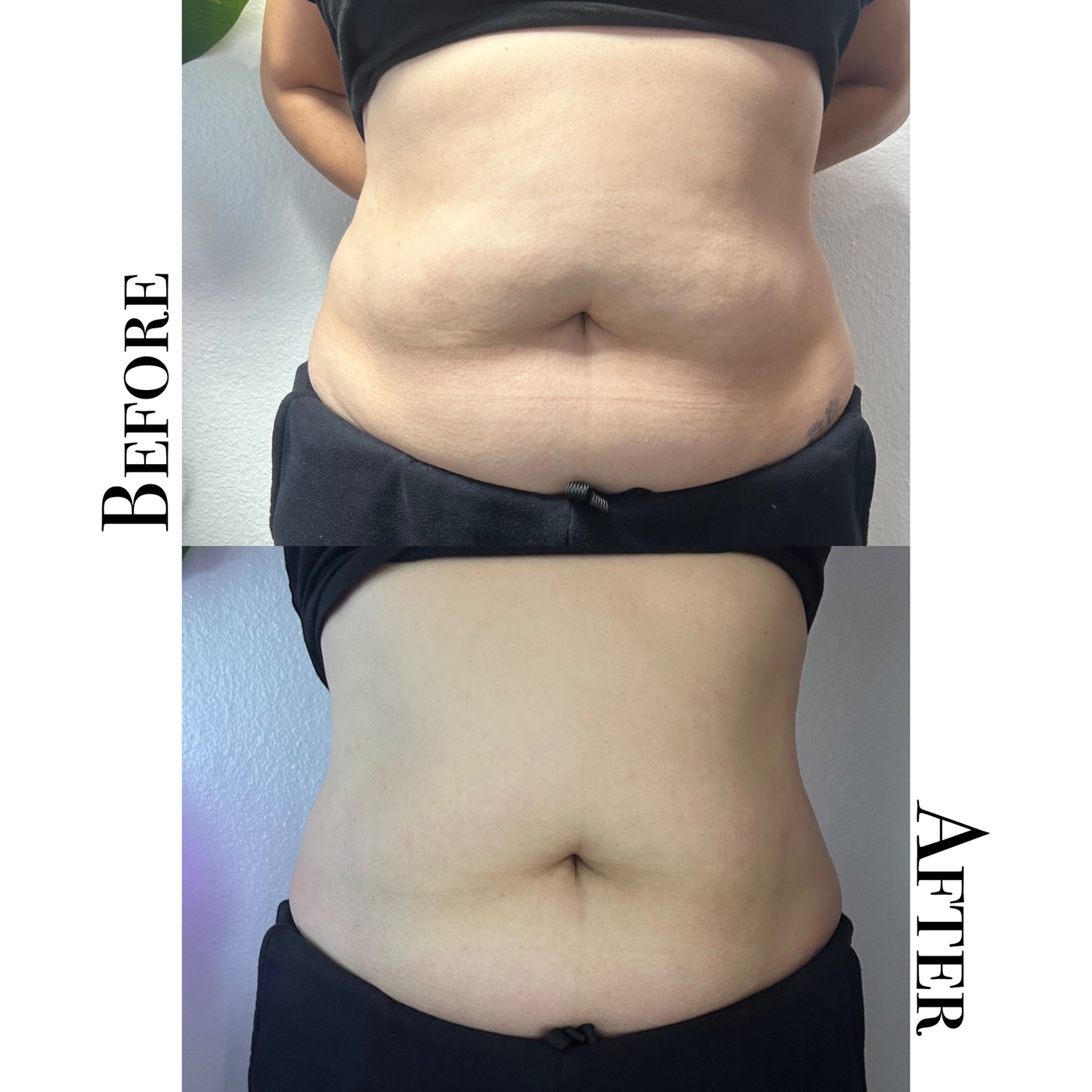 Before and after of a body sculpting series on the abdomen