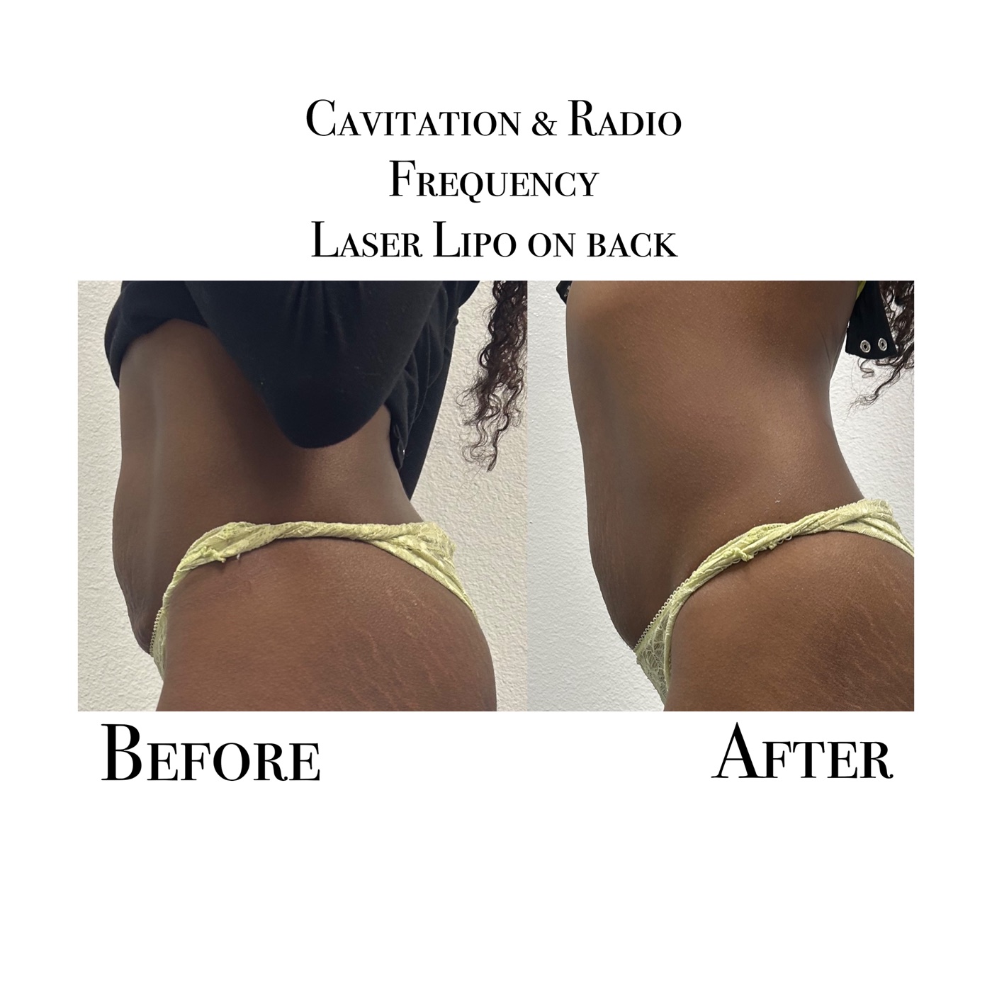 Before and after results of cavitation, radio frequency and laser lipo body sculpting