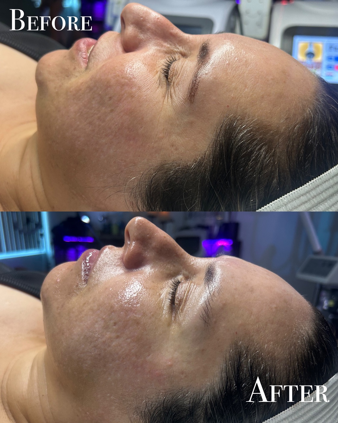 Close-up before and after showing refined pores after a facial