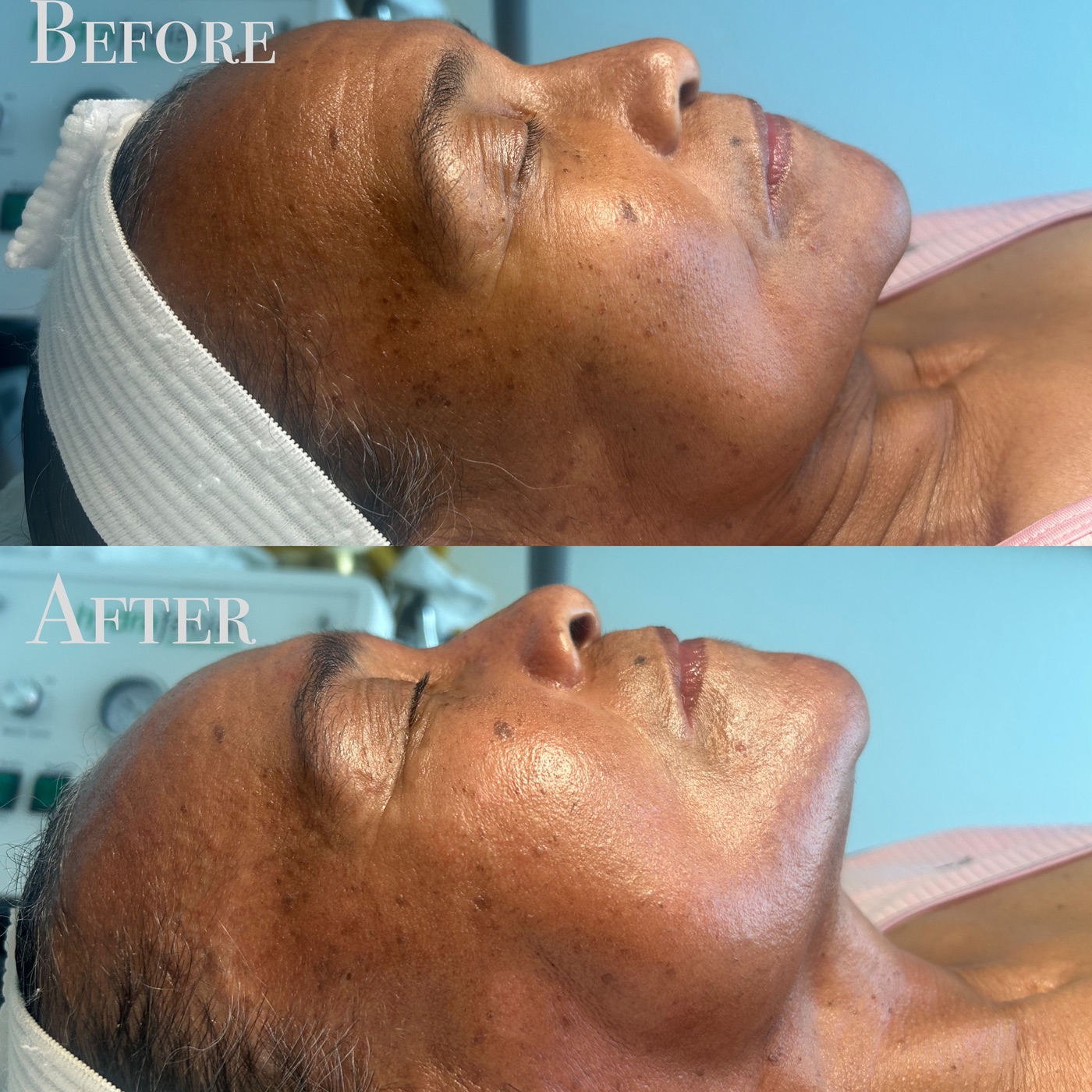 Before and after of a brightening facial on mature skin