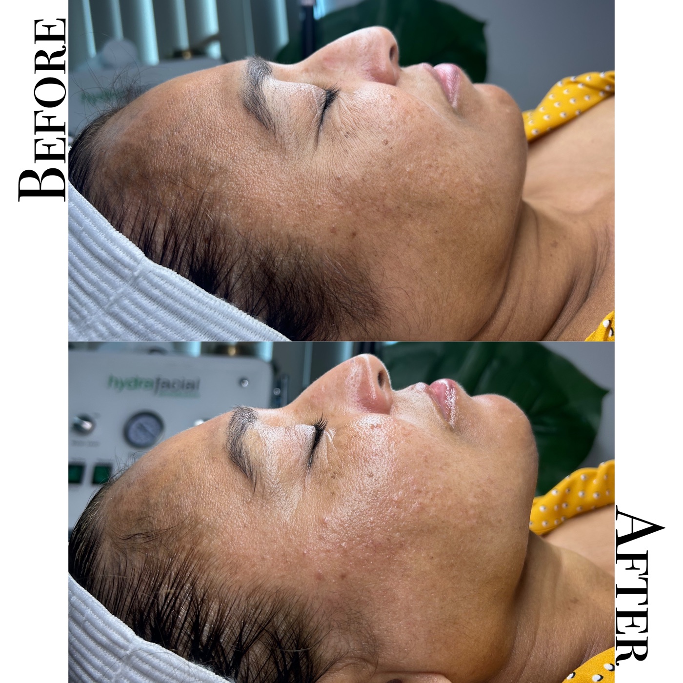 Before and after results of a hydro facial treatment