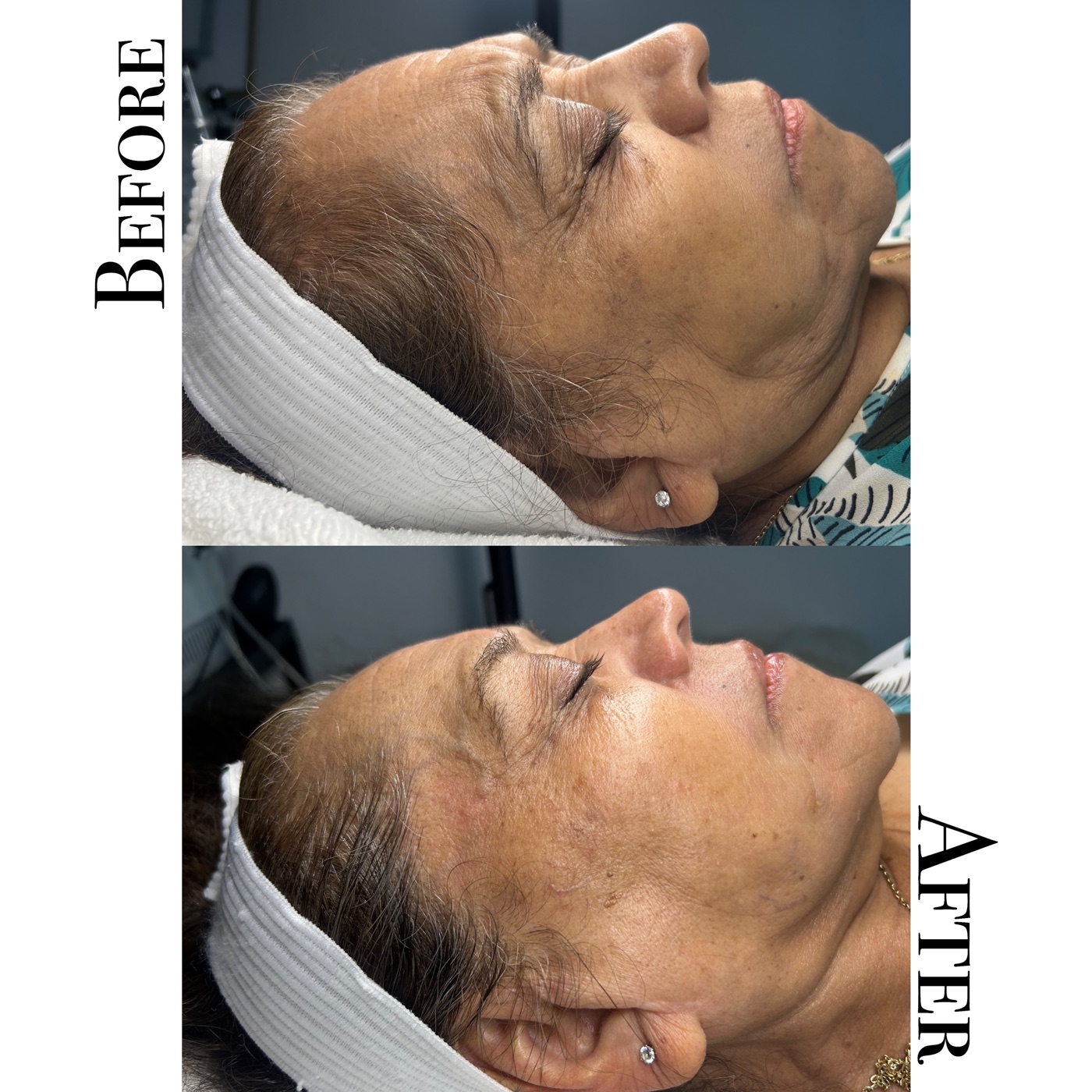 Before and after of an anti-aging facial on mature skin